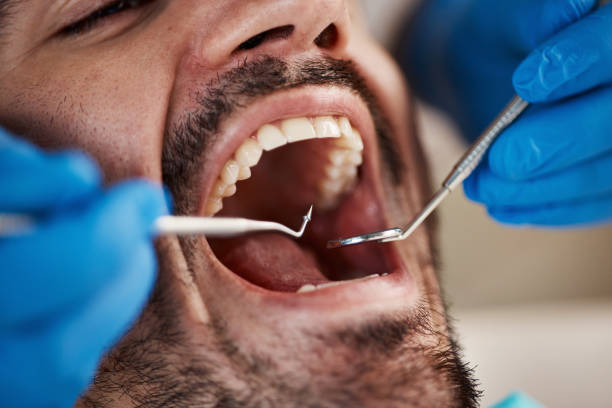 Best Emergency Dentist for Lost Fillings or Crowns in Woodbourne, PA